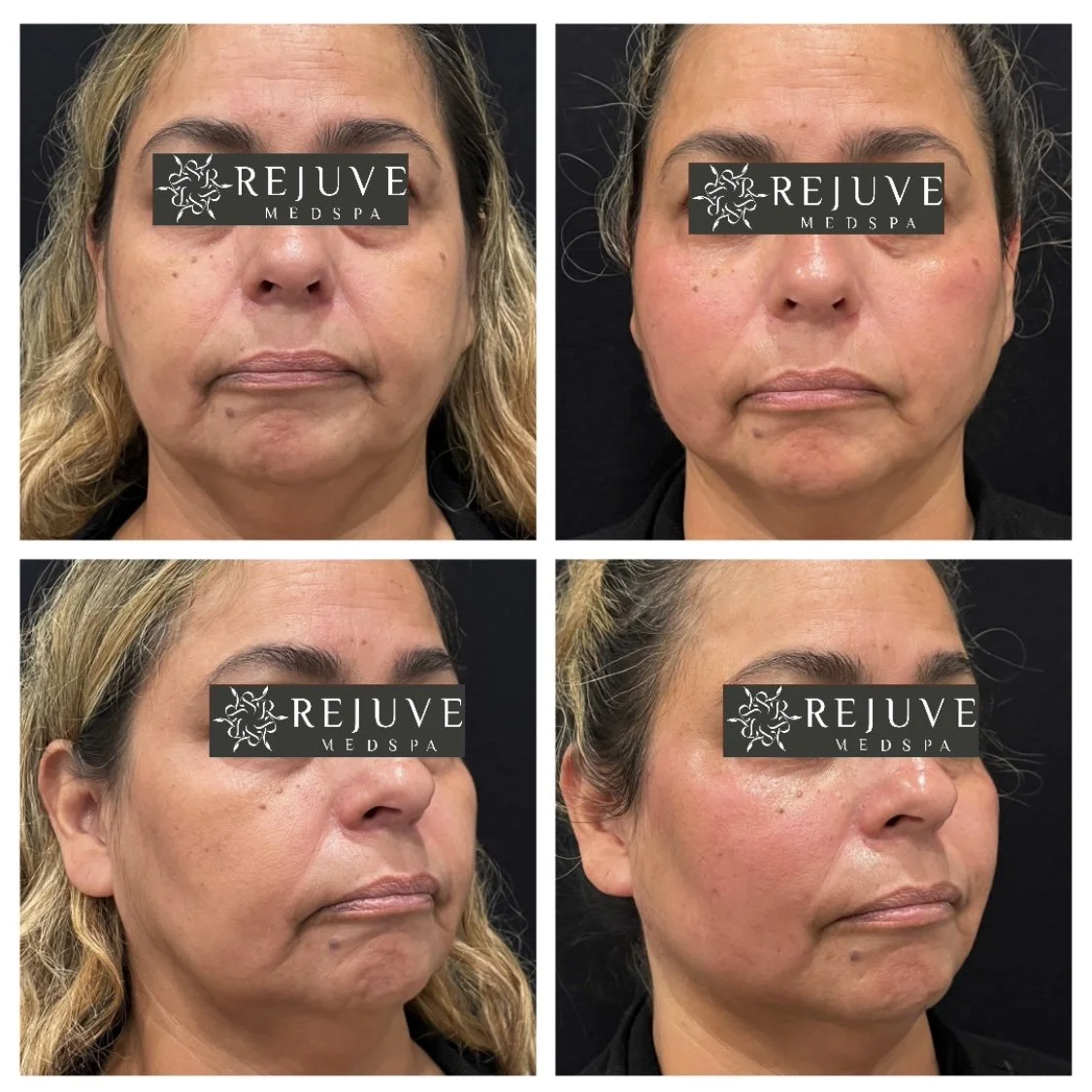 PDO Thread Lift Instant Nonsurgical Facelift with Threads — Rejuve